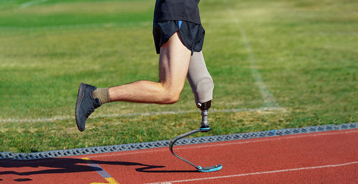 How Prosthetics can help to Improve QoL in Patients who have Lost Limb/s